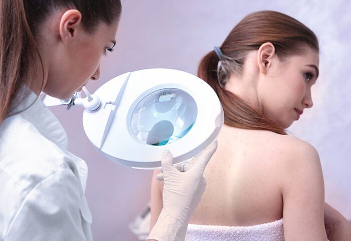 Rak kože: Za melanom ste čuli, a koja su druga maligna oboljenja kože?