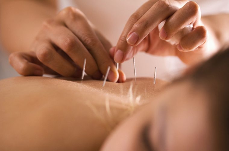 akupunktura na uputnicu