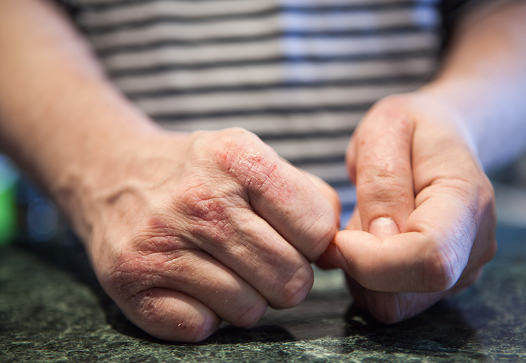 psorijaza, kožne bolesti, simptomi psorijaze, liječenje psorijaze