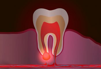 Granulom: terapija granuloma za liječenje zuba