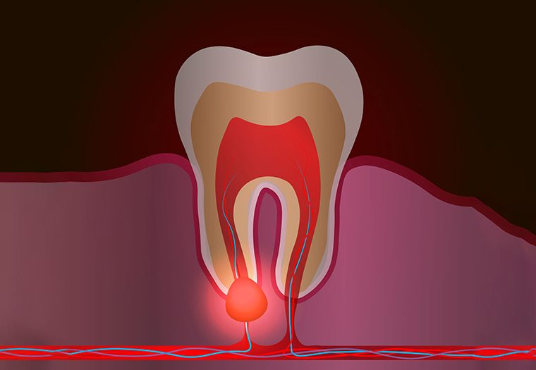 bolovi u zglobovima nakon zubnog liječenja