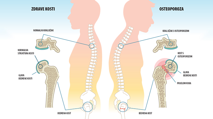 osteoporoza kuka zglobovi za liječenje bolova u zglobovima