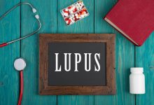 lupus je autoimuna bolest a ovo su najčešći simptomi
