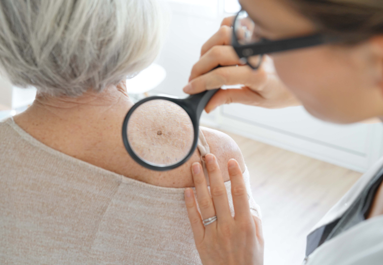 rak kože - za melanom ste čuli a evo koja su druga maligna oboljenja kože