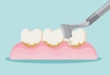 Zdravlje zubi Čistite zubni plak jer zbog njega može nastati zubni kamenac