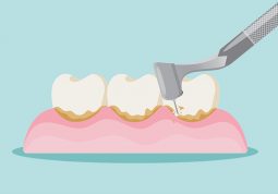 Zdravlje zubi Čistite zubni plak jer zbog njega može nastati zubni kamenac
