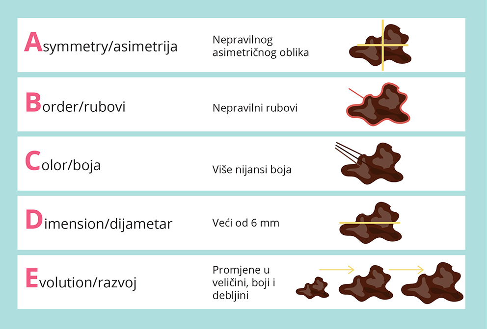 rak koze melanom maligna oboljenja koze dermatologija madezi2