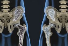 osteoporoza kosti krhke kosti lomljive kosti