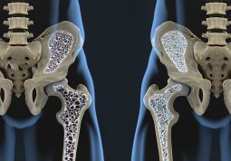 osteoporoza kosti krhke kosti lomljive kosti