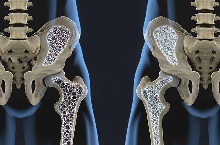 osteoporoza kosti krhke kosti lomljive kosti