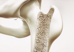 metabolicke bolesti kostiju osteoporoza giht pagetova bolest osteomalacija rahitis