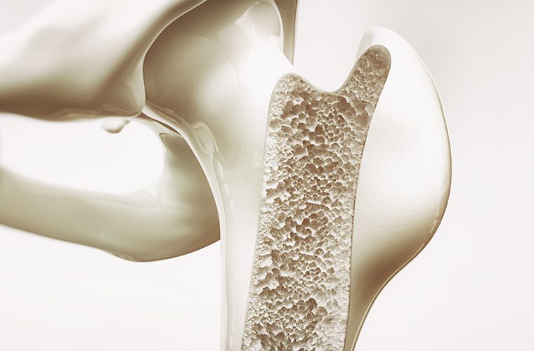 metabolicke bolesti kostiju osteoporoza giht pagetova bolest osteomalacija rahitis
