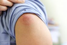 alergije na cjepiva alergijske reakcije nuspojave cijepljenje cjepivo