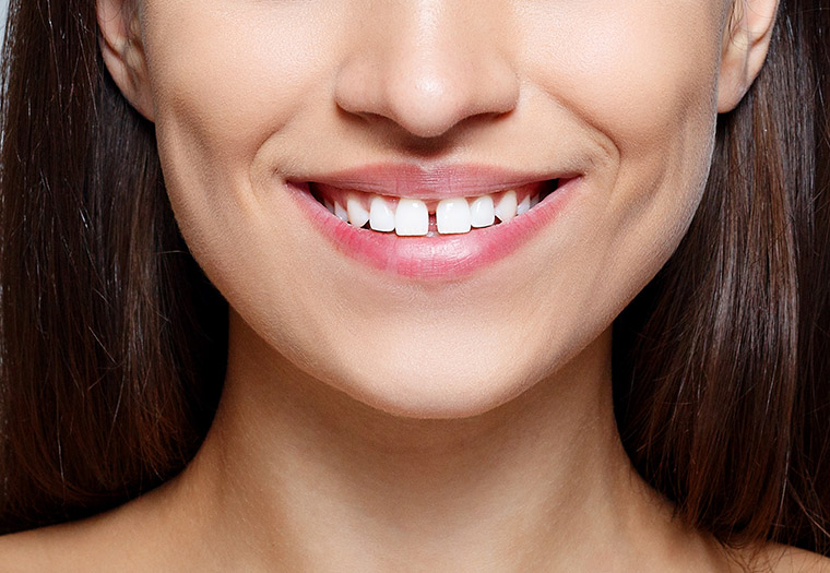 razmak izmedu zubi dijastema