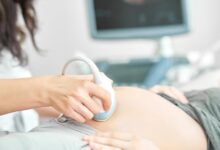 placenta previja problem trudnoća posteljica