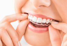 aligneri za zube prozirne udlage za zube