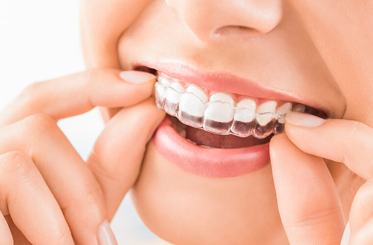aligneri za zube prozirne udlage za zube