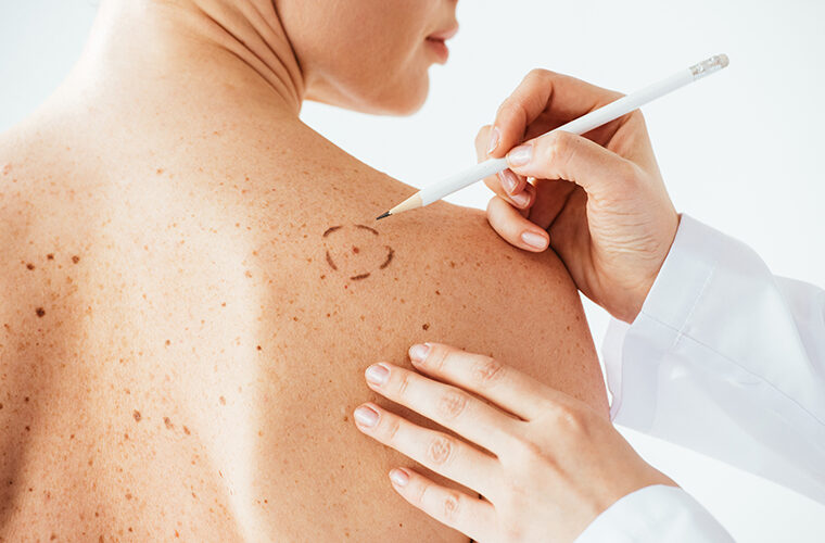 vodic kroz lijecenje melanoma