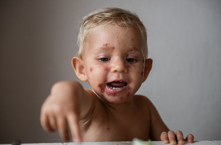 impetigo ili tzv slatke kraste - uzroci, simptomi i liječenje