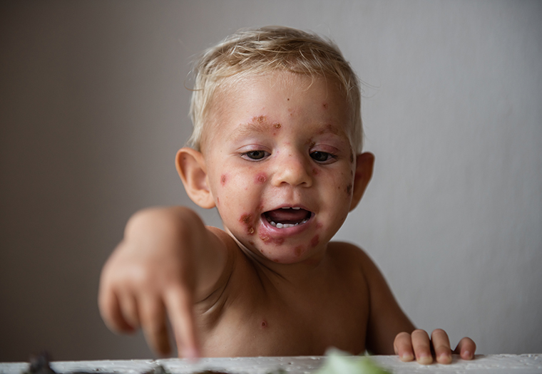 impetigo ili tzv slatke kraste - uzroci, simptomi i liječenje