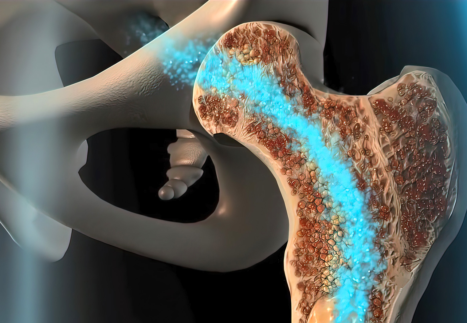osteoporoza i usporavanje bolesti kostiju