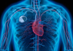 srce-pacemaker-kardioverter defibrilator