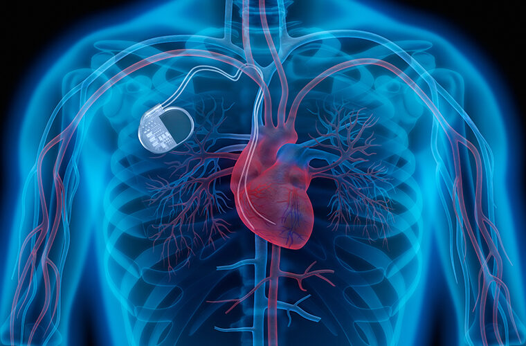 srce-pacemaker-kardioverter defibrilator