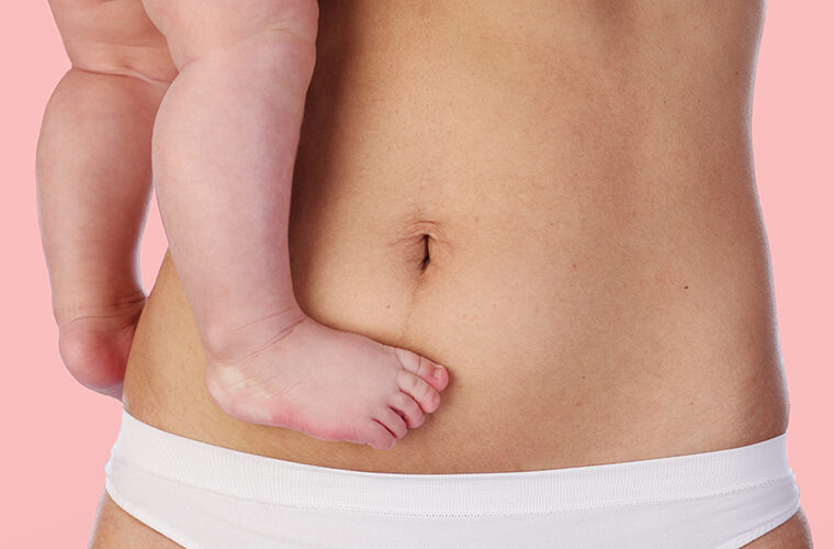 dijastaza-trudnički trbuh