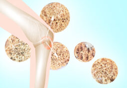 Svjetski dan osteoporoze-denzitometrija kostiju