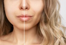 buccal fat removal-uklanjanje bukalne masnoće