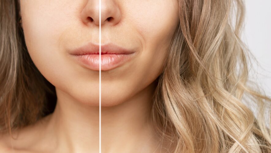 buccal fat removal-uklanjanje bukalne masnoće