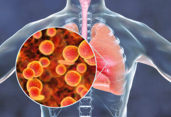 Hodajuća upala pluća-Mycoplasma-pneumoniae