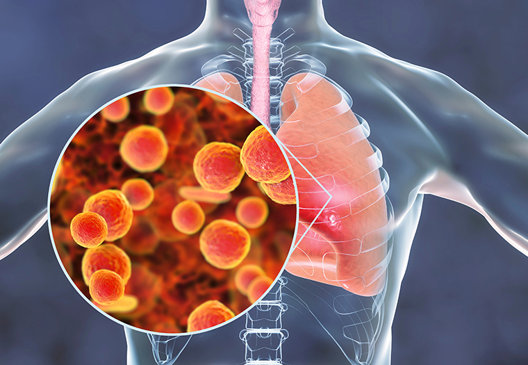 Hodajuća upala pluća-Mycoplasma-pneumoniae