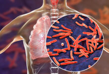 tuberkuloza i dalje predstavlja prijetnju