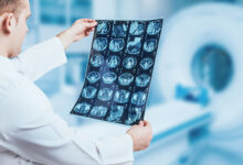 MR u otkrivanju Alzheimerove bolesti