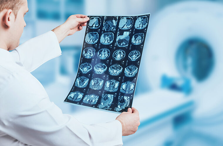 MR u otkrivanju Alzheimerove bolesti