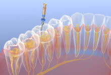 korekcija endodontskog liječenja