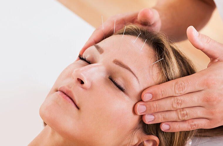 liječenje glavobolje i migrene akupunkturom