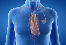 pacemaker-elektrostimulator srca
