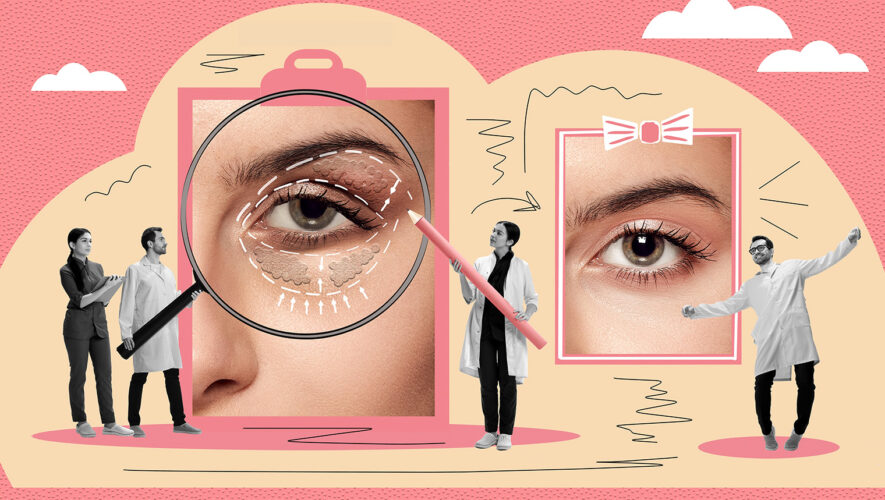 blefaroplastika ocni kapak vjede