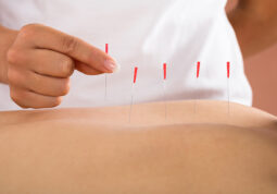 dry needling za liječenje boli
