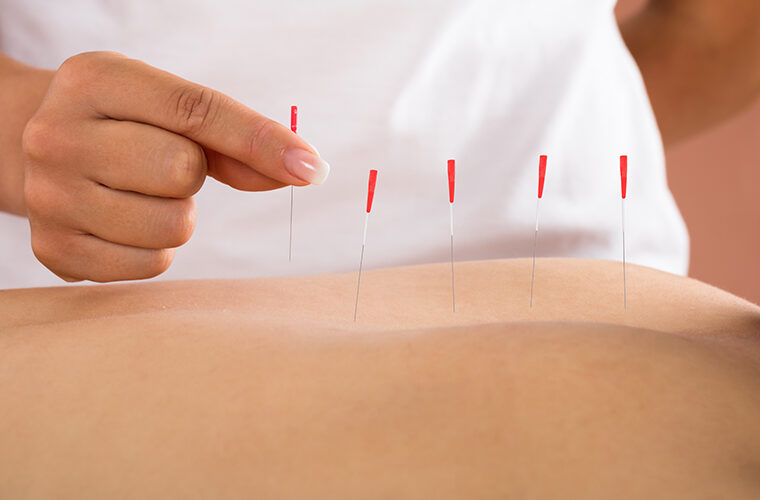 dry needling za liječenje boli