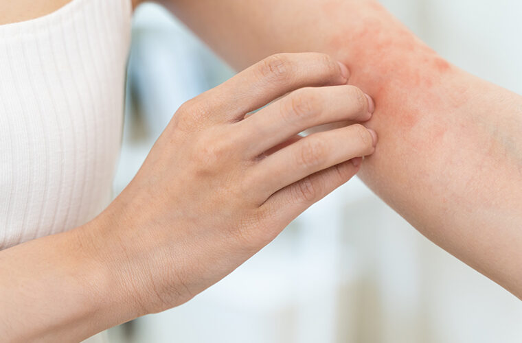 atopijski dermatitis odrasli