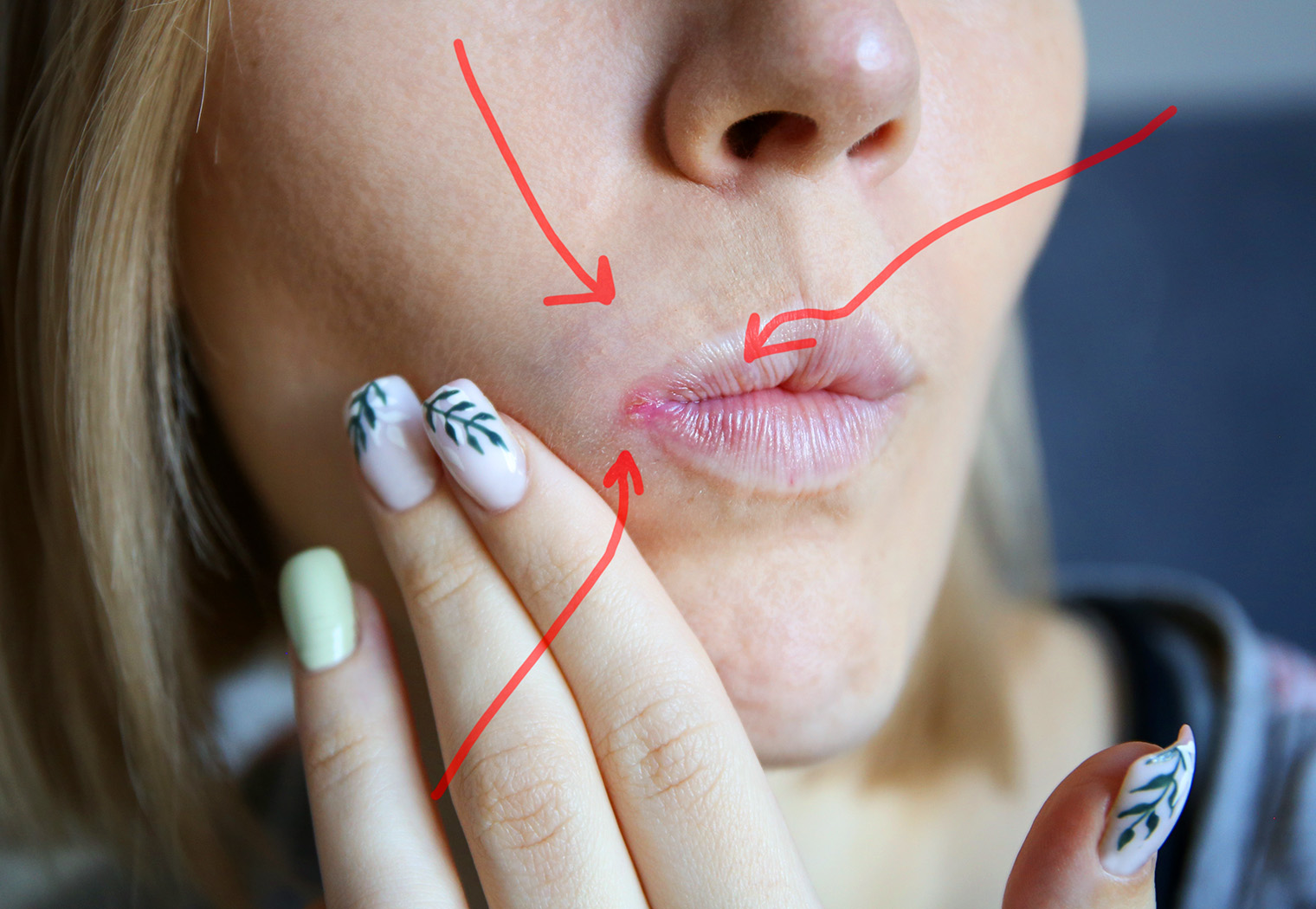 heilitis zvale upala