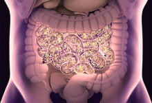 SIBO – Small Intestine Bacterial Overgrowth
