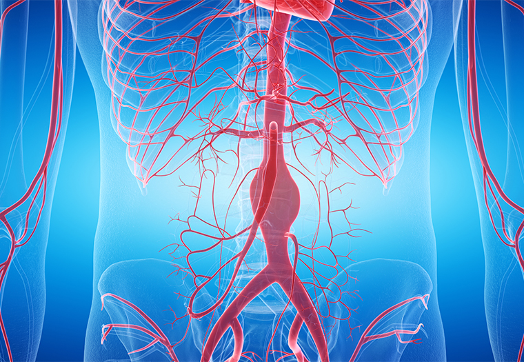 aneurizma abdominalne aorte
