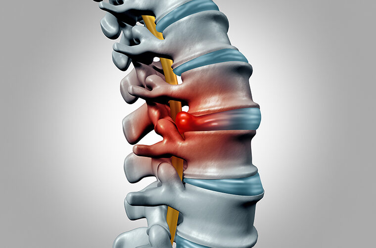 PLDD-hernija diska