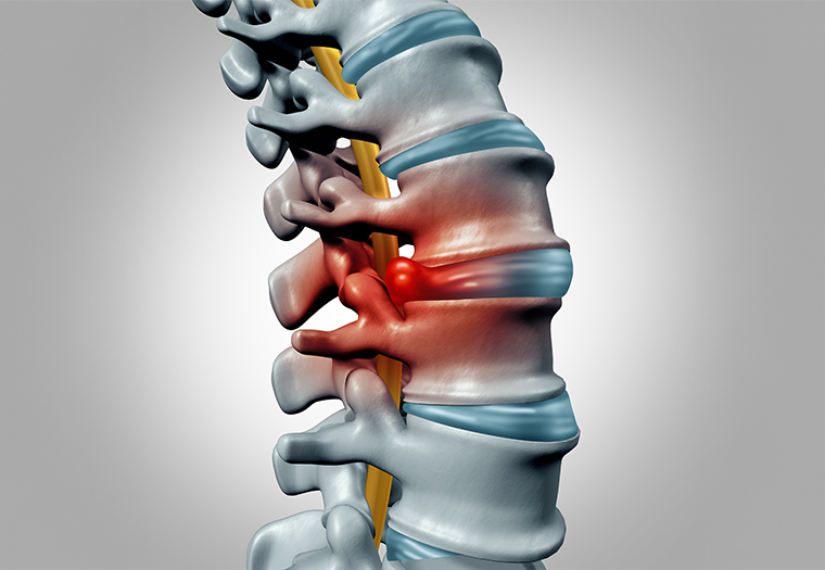PLDD-hernija diska