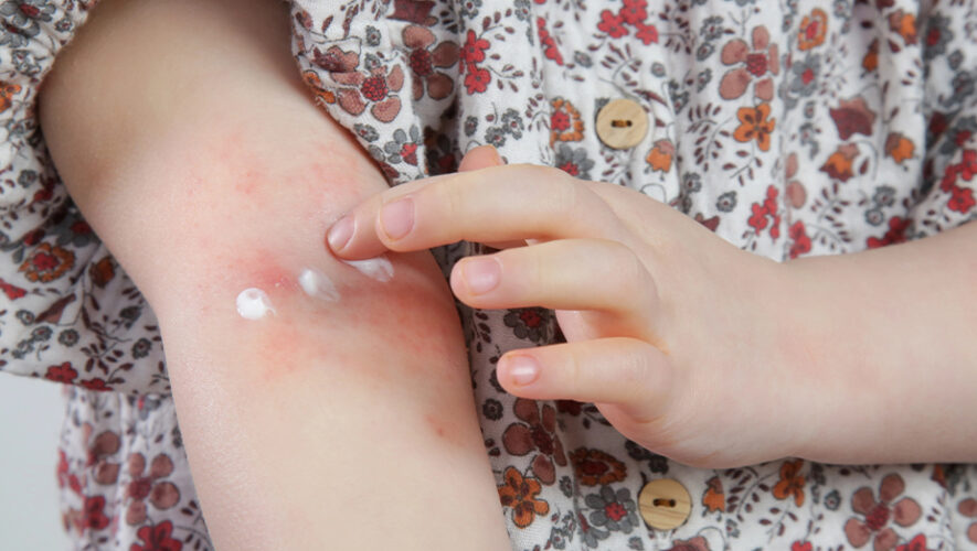 Kako prepoznati razliku izmedu suhe kozze i atopijskog dermatitisa 2