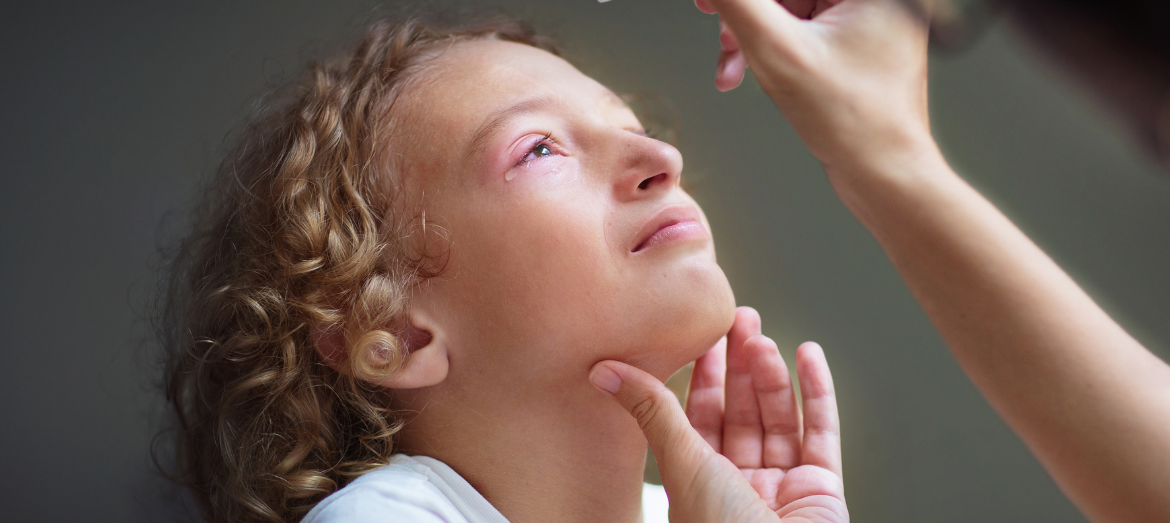 Konjunktivitis kod djece